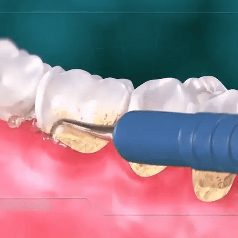 IRRIGADOR PROFESIONAL ORAL ANTISARRO RECARGABLE 4 BOQUILLAS ¡SUPER PROMO!
